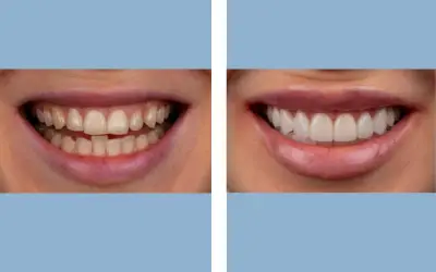 Before and After